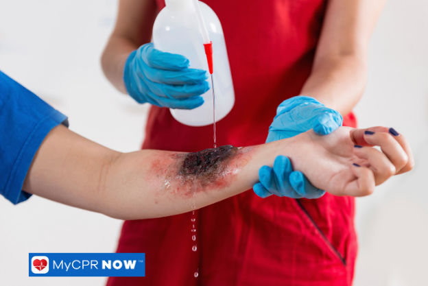 Cleaning a severe arm burn with antiseptic solution